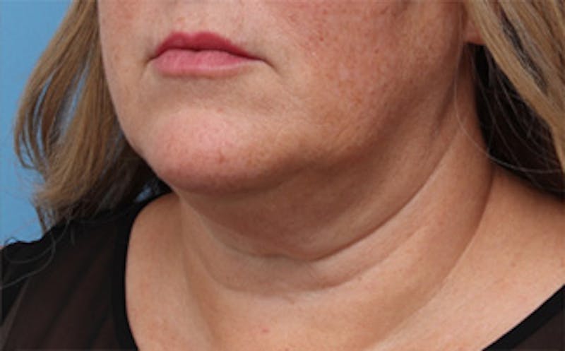 FaceTite Before & After Gallery - Patient 163386 - Image 3