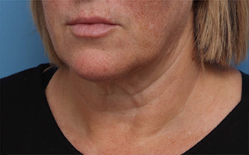 FaceTite Before & After Gallery - Patient 163386 - Image 4