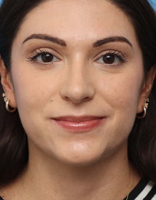 FaceTite Before & After Gallery - Patient 275108 - Image 2