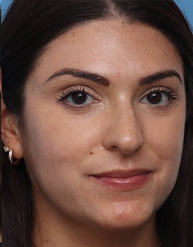Rhinoplasty  Before & After Gallery - Patient 356224 - Image 5