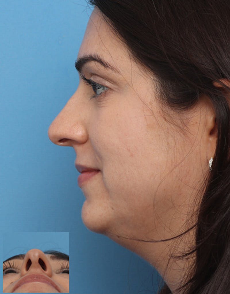 Patient KahnUxcmSwufaJKKBlK3Qg - FaceTite Before & After Photos