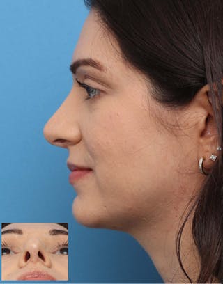 FaceTite Before & After Gallery - Patient 275108 - Image 8