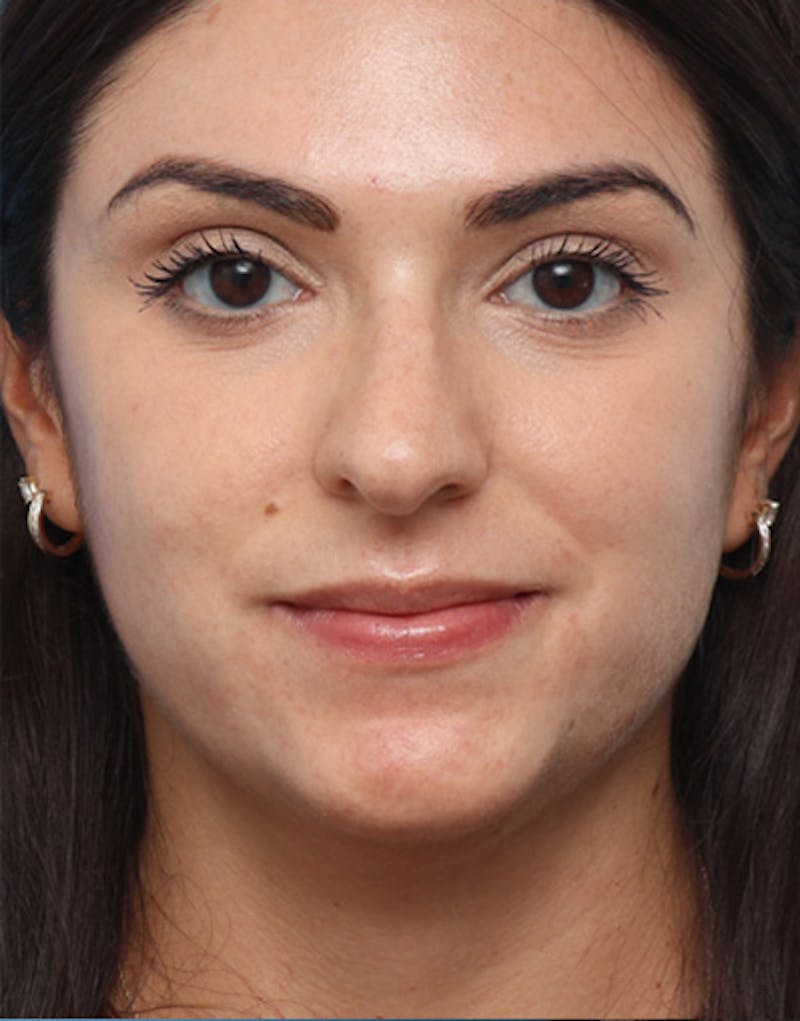 Patient JJNEgQJ8RvmvvVWbBFmDKg - FaceTite Before & After Photos