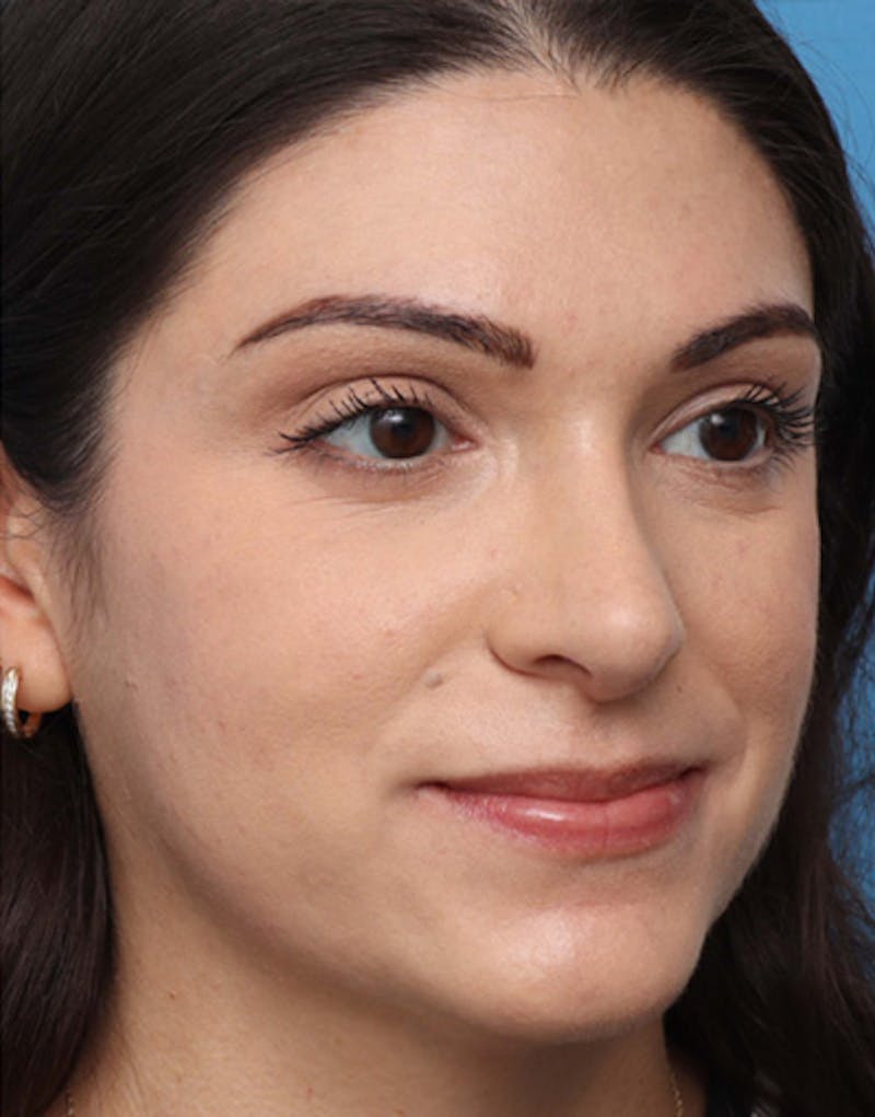 Rhinoplasty  Before & After Gallery - Patient 356224 - Image 6