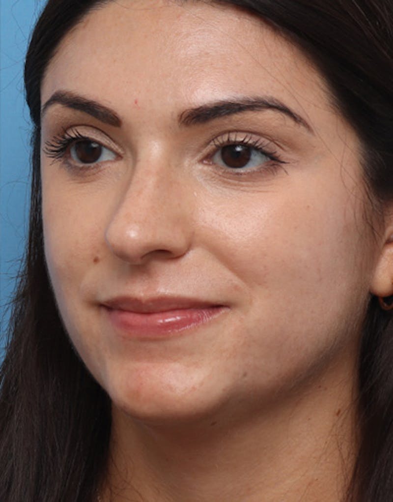 Rhinoplasty  Before & After Gallery - Patient 356224 - Image 7
