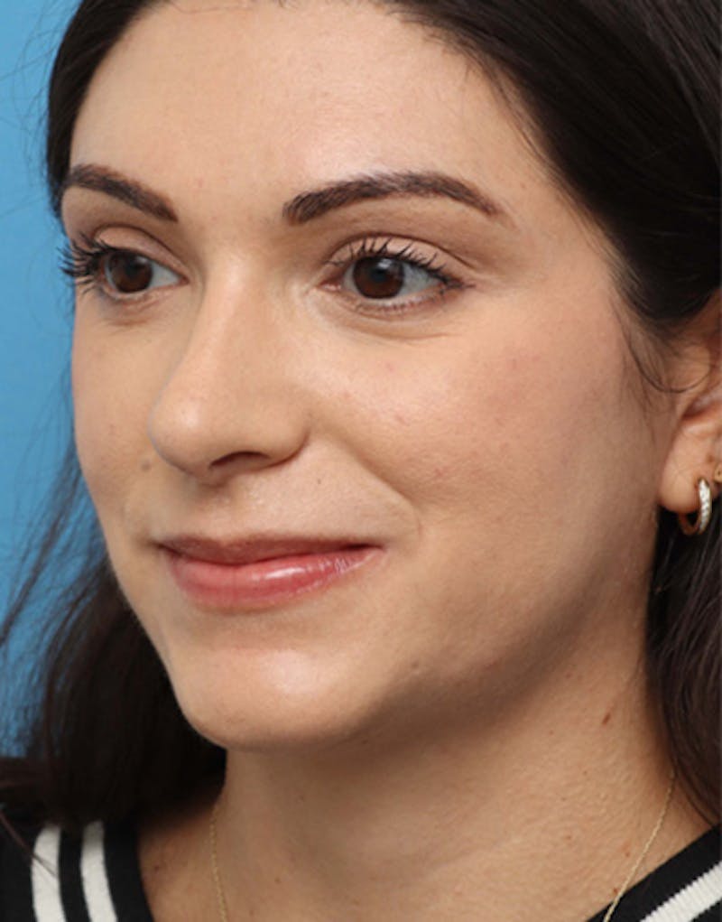Rhinoplasty  Before & After Gallery - Patient 356224 - Image 8