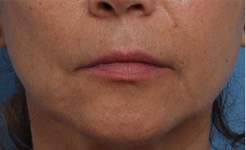 Patient MoJQ54RhRO6URRLPsO6koQ - Before & After Photos