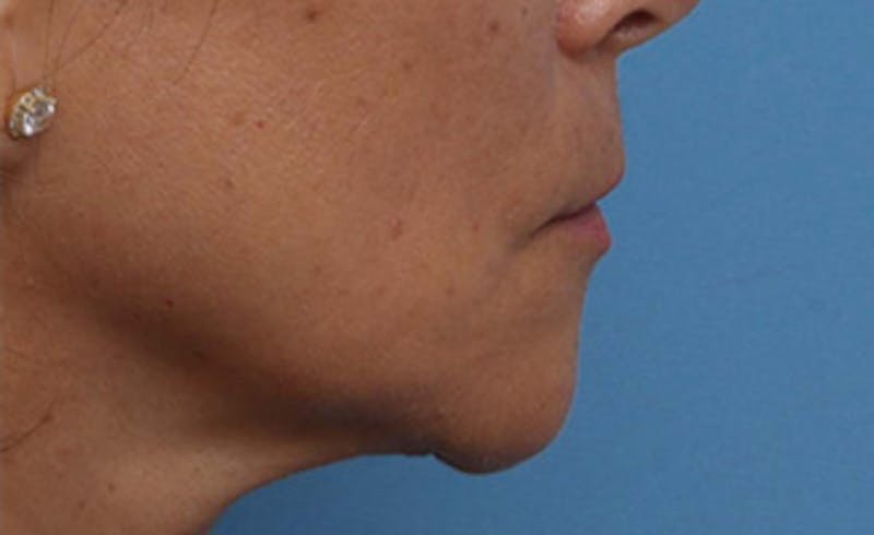 Lip Lift Before & After Gallery - Patient 163407 - Image 5