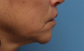 Lip Lift Before & After Gallery - Patient 163407 - Image 6
