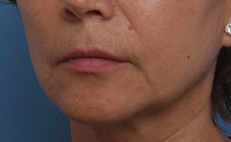 Lip Lift Before & After Gallery - Patient 163407 - Image 7