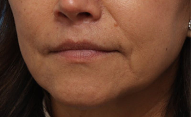 Lip Lift Before & After Gallery - Patient 163407 - Image 8