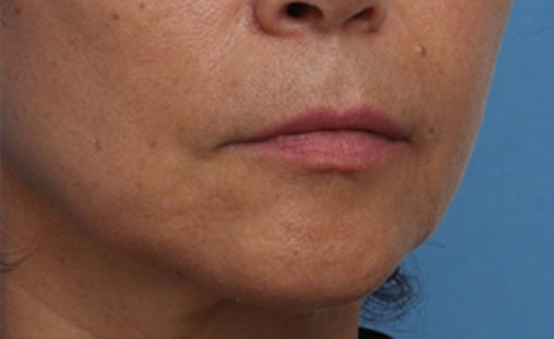 Lip Lift Before & After Gallery - Patient 163407 - Image 3