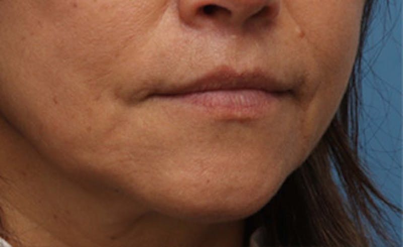 Lip Lift Before & After Gallery - Patient 163407 - Image 4