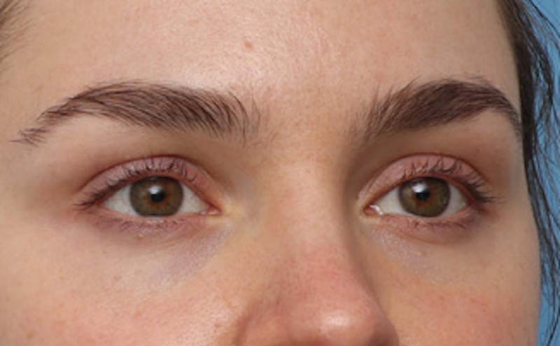 Fillers Before & After Gallery - Patient 383447 - Image 3