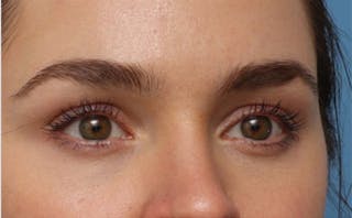 EZ Gel PRF Before & After Gallery - Patient 359875 - Image 4