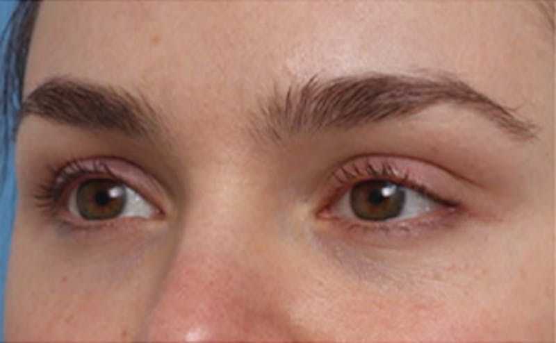 Fillers Before & After Gallery - Patient 383447 - Image 5