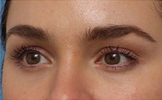 EZ Gel PRF Before & After Gallery - Patient 359875 - Image 6