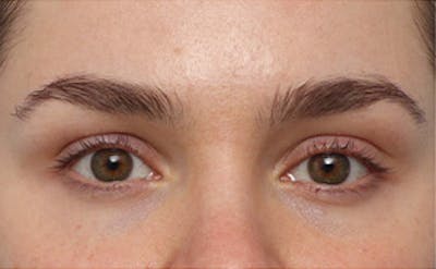 EZ Gel PRF Before & After Gallery - Patient 359875 - Image 1