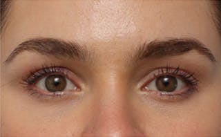 EZ Gel PRF Before & After Gallery - Patient 359875 - Image 2