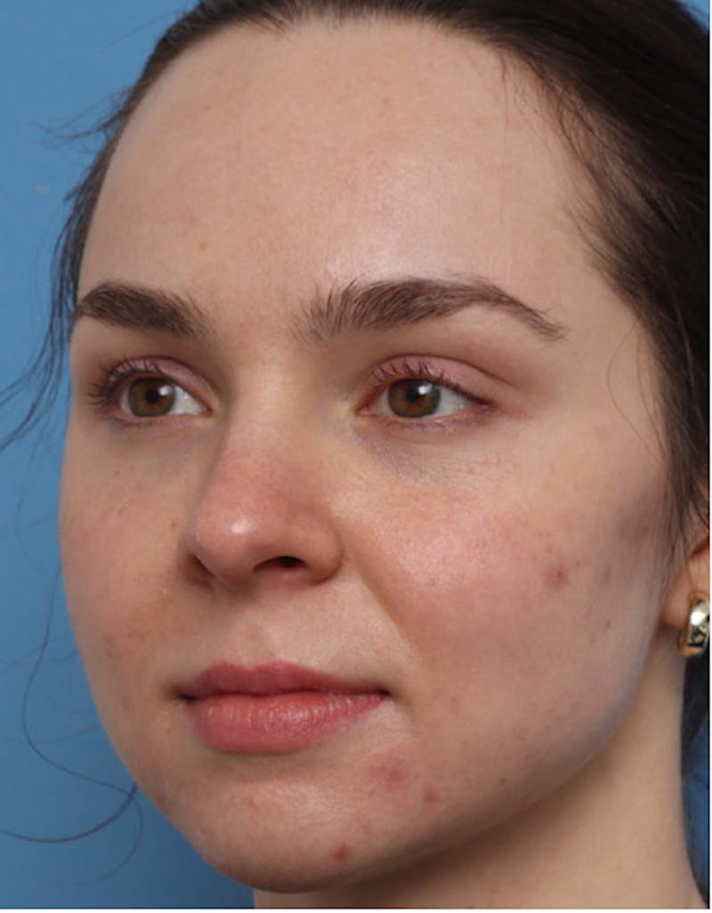 Fillers Before & After Gallery - Patient 383447 - Image 9