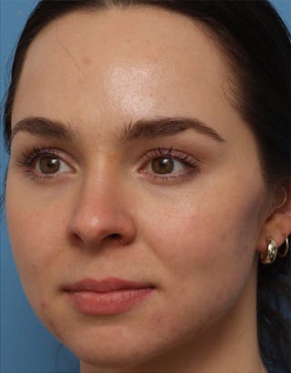 EZ Gel PRF Before & After Gallery - Patient 372203 - Image 4