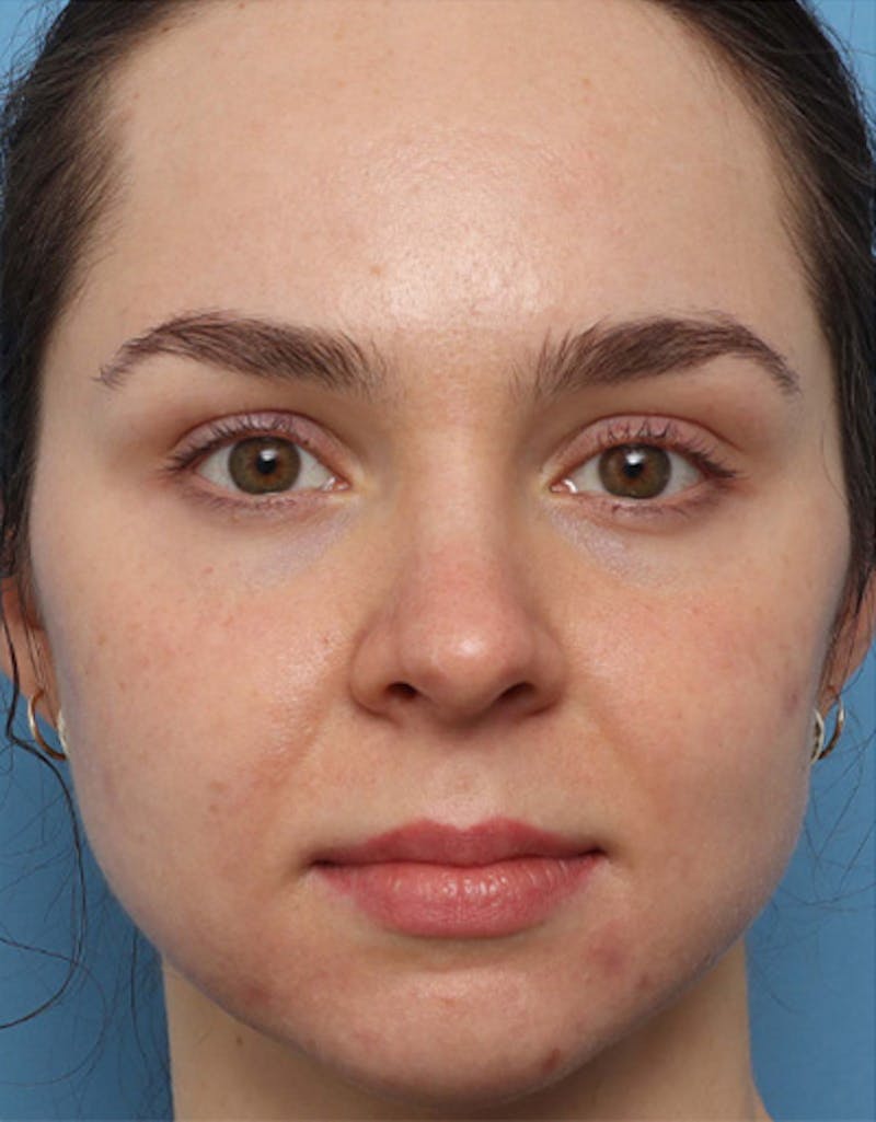 Patient WOvkMYyCSrCFSLAOF95zrA - Fillers Before & After Photos