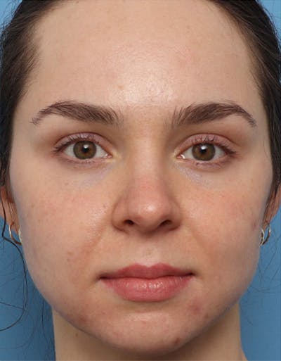 EZ Gel PRF Before & After Gallery - Patient 372203 - Image 1