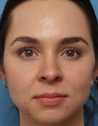 EZ Gel PRF Before & After Gallery - Patient 372203 - Image 2