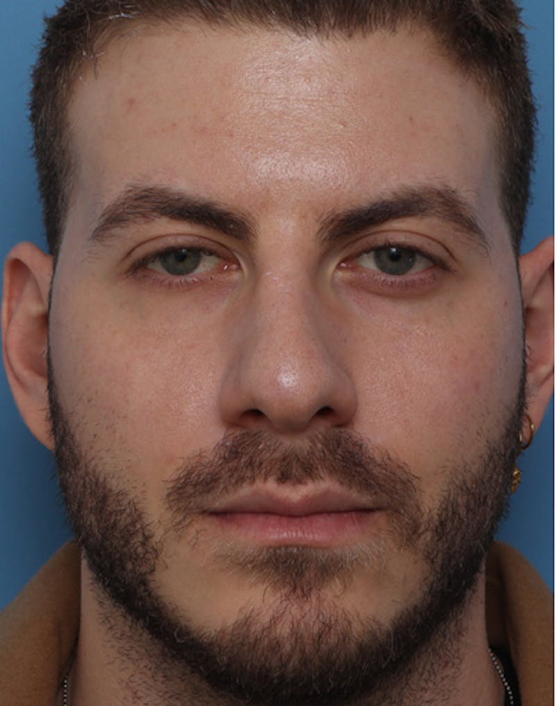 Rhinoplasty  Before & After Gallery - Patient 143439 - Image 5