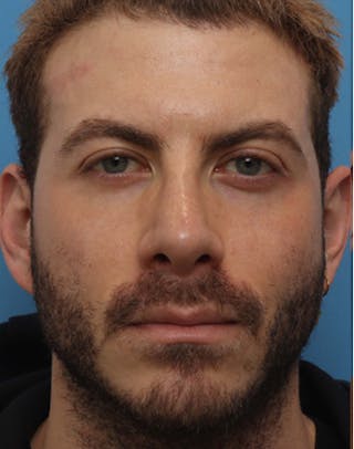 Rhinoplasty Before & After Gallery - Patient 143439 - Image 6