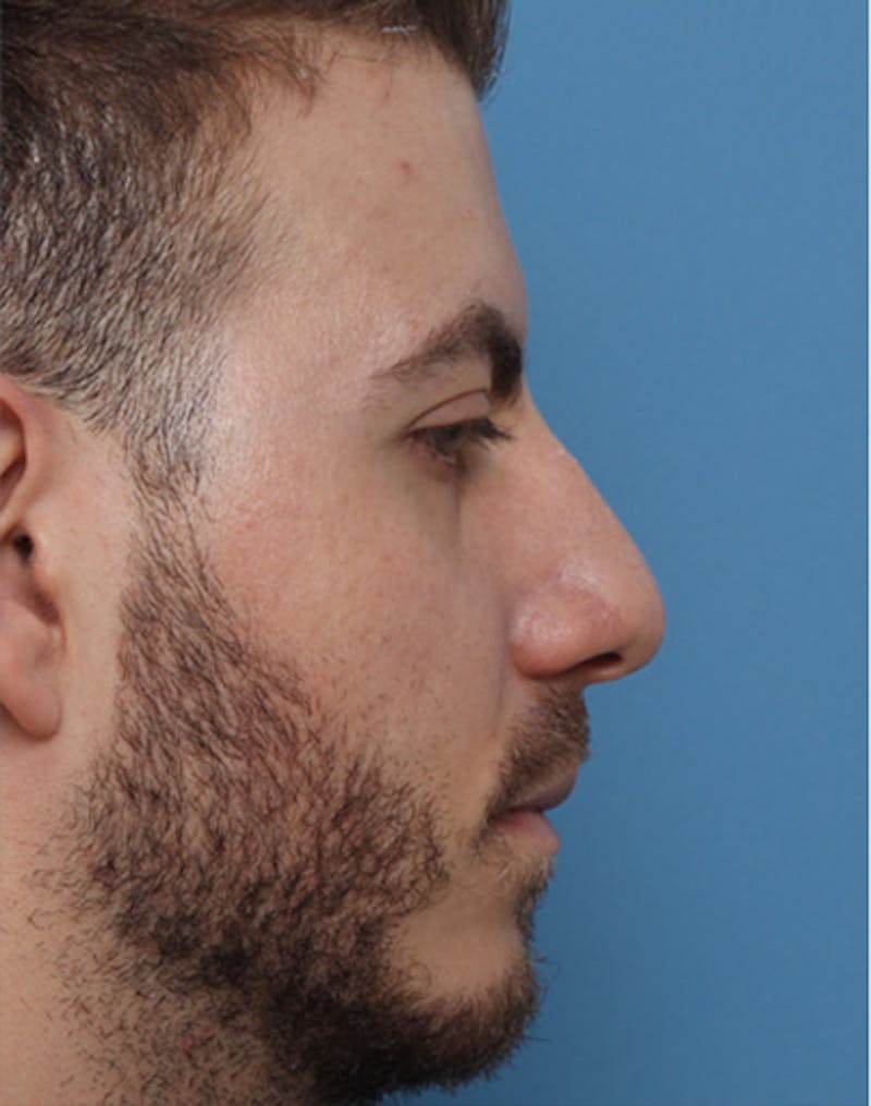 Patient VDkhuuEZQiCJ_iU-yUIAFg - Rhinoplasty Before & After Photos