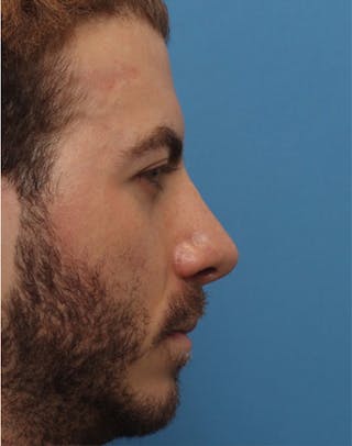 Rhinoplasty Before & After Gallery - Patient 143439 - Image 2