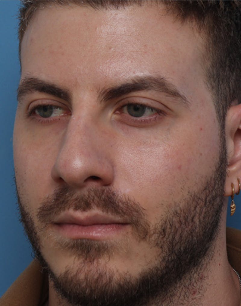 Rhinoplasty  Before & After Gallery - Patient 143439 - Image 7