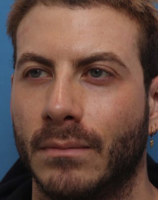 Rhinoplasty Before & After Gallery - Patient 143439 - Image 8