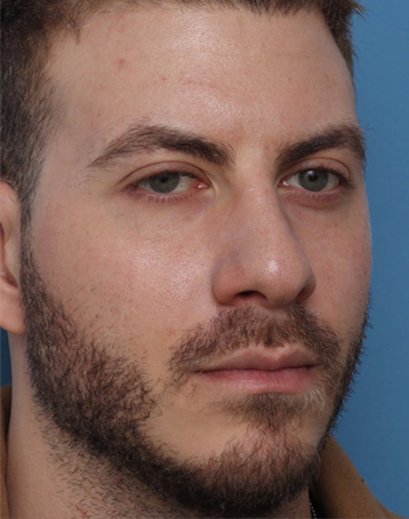 Rhinoplasty  Before & After Gallery - Patient 143439 - Image 3