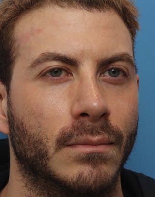 Rhinoplasty Before & After Gallery - Patient 143439 - Image 4