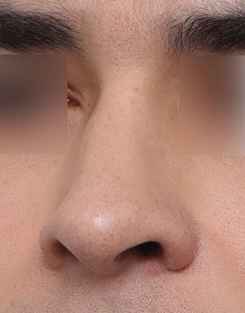 Patient GjZC_fVdRneSz-b6VHBXnA - Before & After Photos