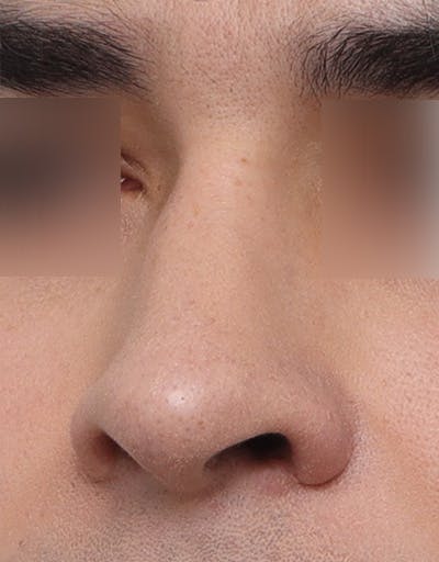 Rhinoplasty Before & After Gallery - Patient 268284 - Image 1