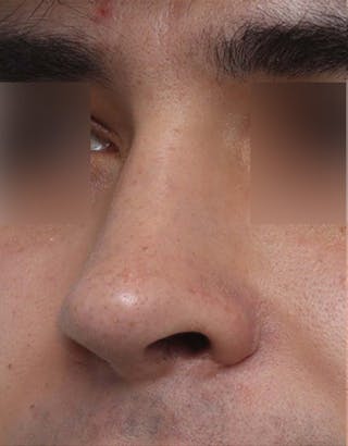 Rhinoplasty Before & After Gallery - Patient 268284 - Image 2