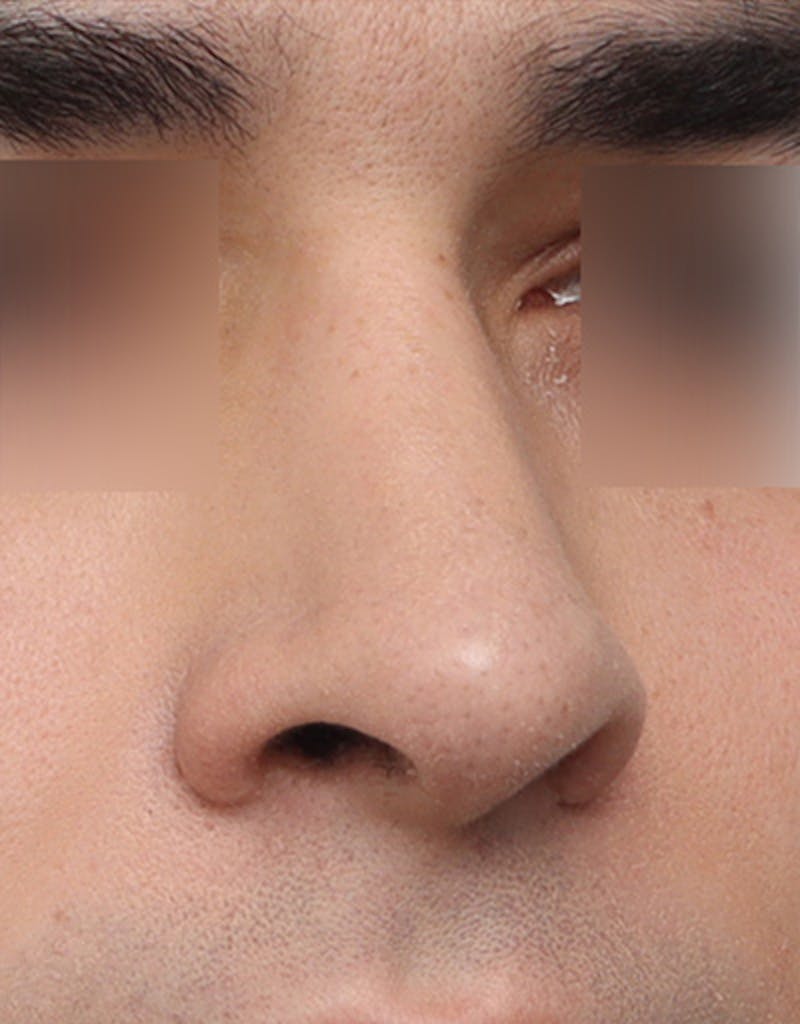Rhinoplasty  Before & After Gallery - Patient 268284 - Image 3
