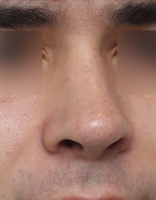 Rhinoplasty Before & After Gallery - Patient 268284 - Image 4