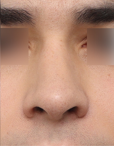 Scar Revision Before & After Photos | Westreich
