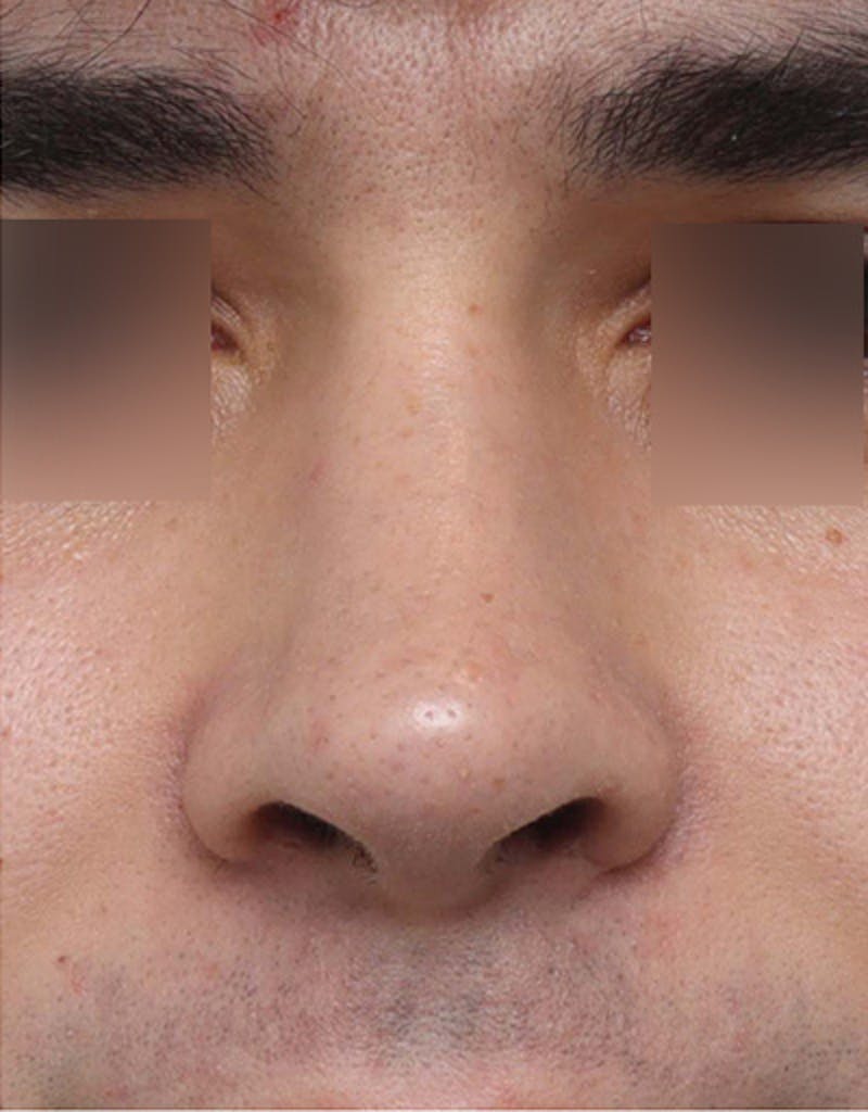Rhinoplasty  Before & After Gallery - Patient 268284 - Image 6