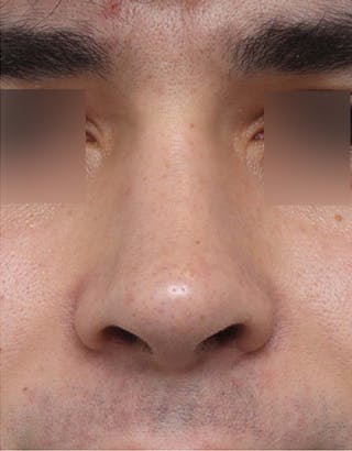 Rhinoplasty Before & After Gallery - Patient 268284 - Image 6