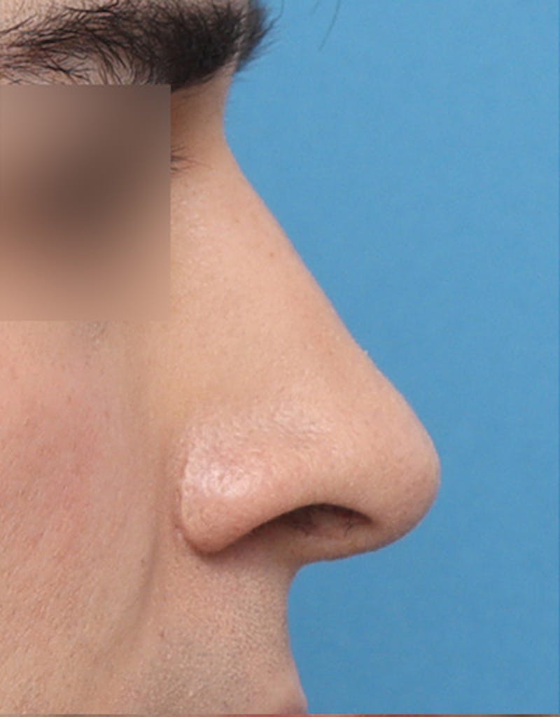Rhinoplasty  Before & After Gallery - Patient 268284 - Image 7
