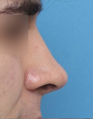 Rhinoplasty Before & After Gallery - Patient 268284 - Image 8