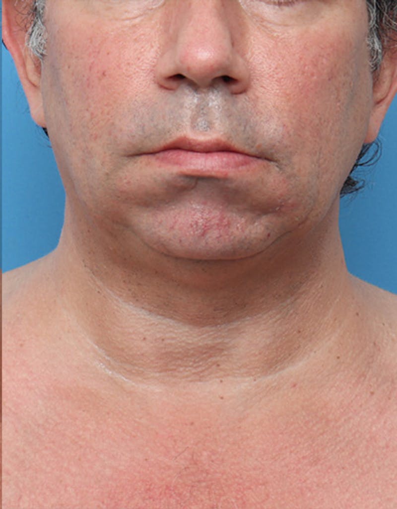 Other Nonsurgical Before & After Gallery - Patient 414834 - Image 3