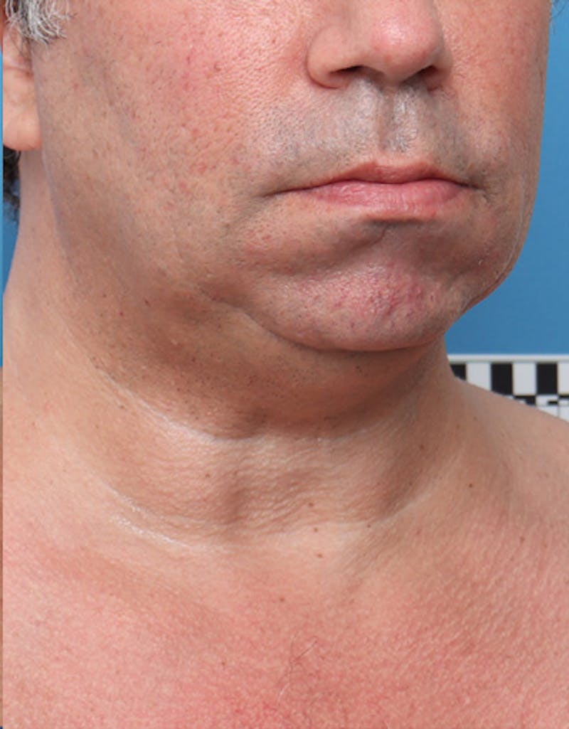 Other Nonsurgical Before & After Gallery - Patient 414834 - Image 5