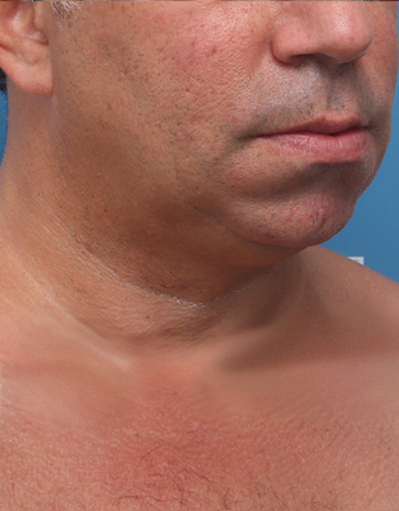 Other Nonsurgical Before & After Gallery - Patient 414834 - Image 6