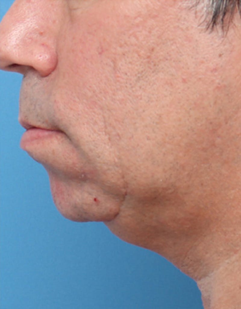 Other Nonsurgical Before & After Gallery - Patient 414834 - Image 7